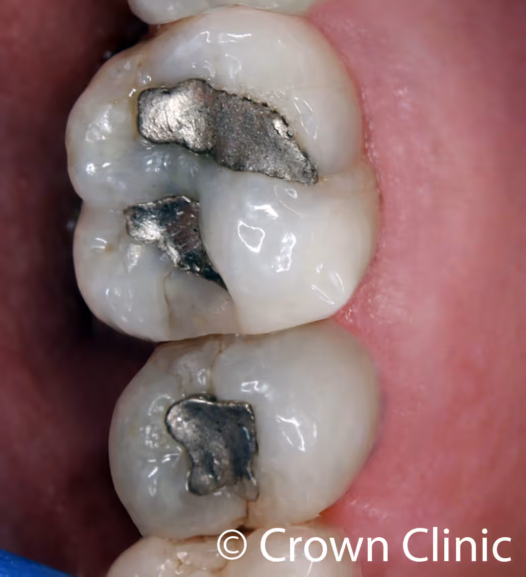 Close-up clinical photo of two upper back molars showing old cracked amalgam fillings with visible tooth fractures before CEREC crown treatment