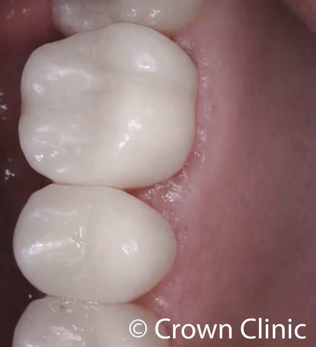 Close-up clinical photo of two upper back molars restored with new white CEREC zirconia crowns, replacing old cracked amalgam fillings