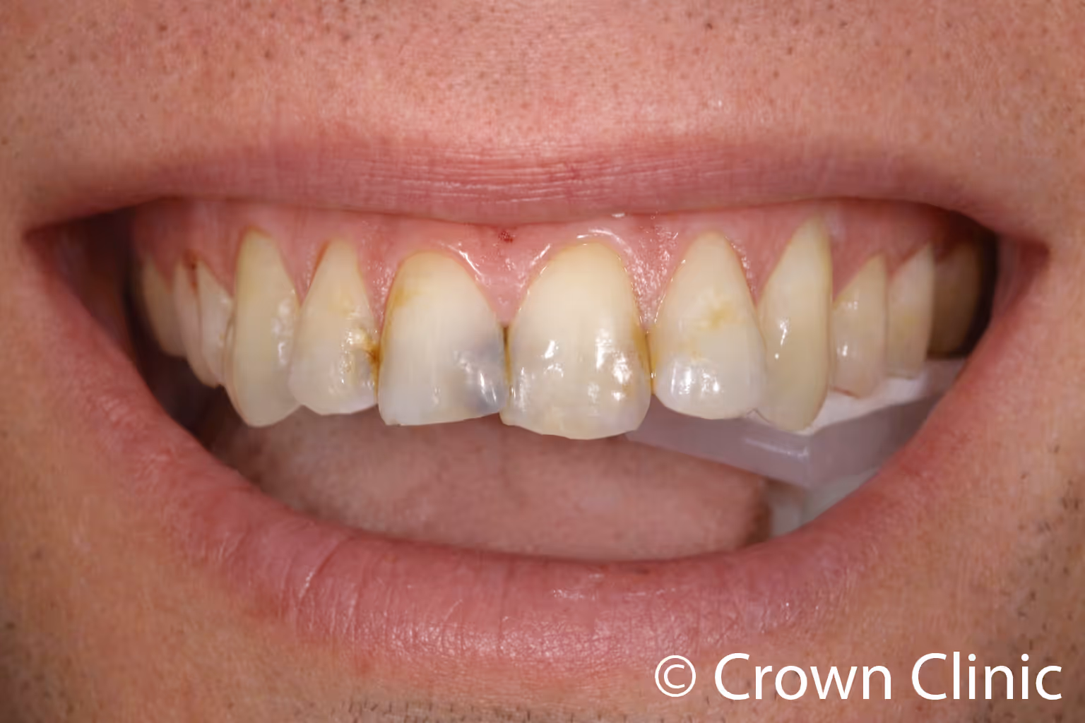 Close-up smile with cheek retractors showing upper and lower front teeth with heavy staining, discoloration, and decay before full-mouth CEREC crown restoration