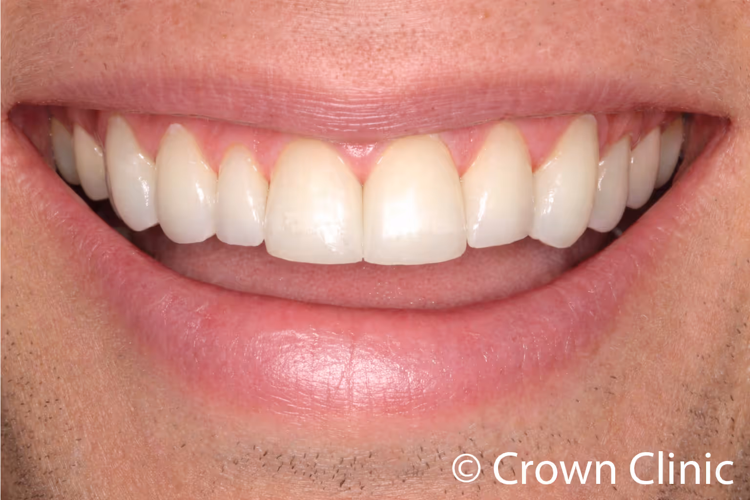 Close-up smile with cheek retractors showing a complete smile makeover with bright white CEREC zirconia crowns on all upper and lower front teeth